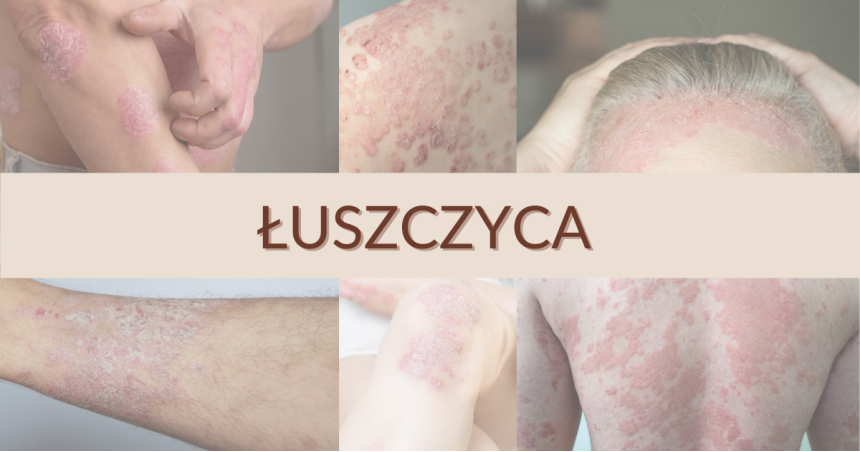 Łuszczyca – wszystko co musisz o niej wiedzieć