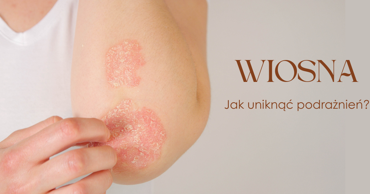 Alergie skórne i egzema na wiosnę – jak unikać podrażnień?