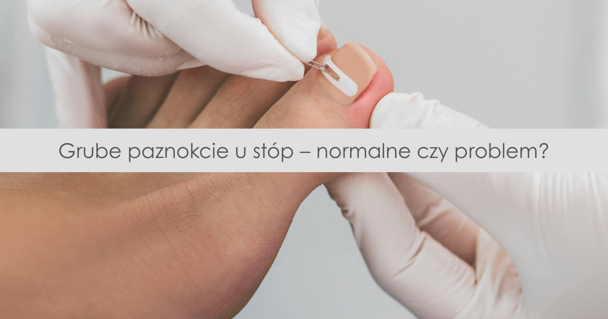 Dlaczego paznokcie u stóp są grubsze niż u rąk